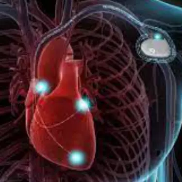 ICD Implant Surgery in India, Heart Failure Treatment in India, Treatment for Arrhythmia in India, Best Cardiologist in Gurgaon for ICD, Best Hospital Cost for ICD, Pacemaker Surgery in Gurgaon Faridabad India