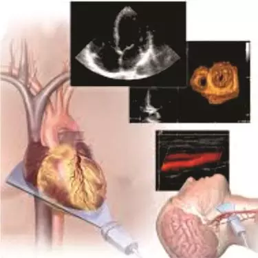 Stress Echo Test in Gurgaon India