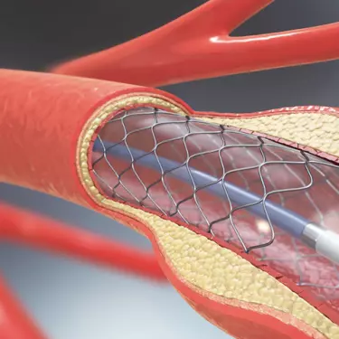 Primary Angioplasty in Gurgaon India